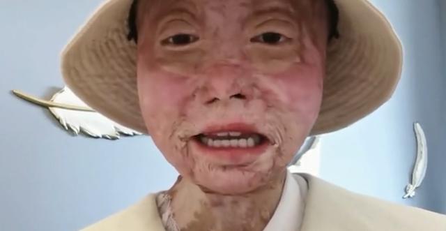乔燕：因汽车自燃被烧伤，全脸毁容双手截肢，928天后涅槃重生