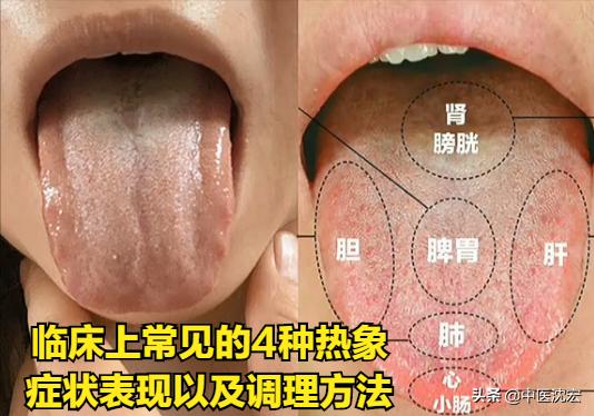 4种“热”藏于体内，不同舌象，不同症状，建议收藏分享给朋友
