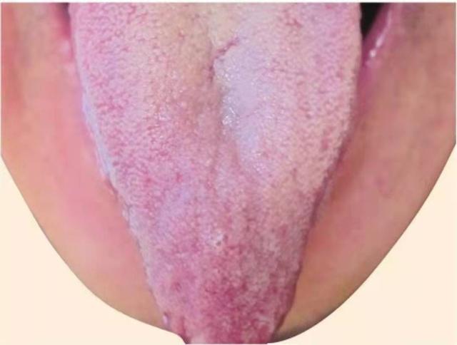 5种常见的失眠证型和舌象，老中医辩证施治，看看你是哪一种？
