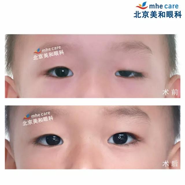 五年八部曲，上睑下垂分阶段治疗的故事