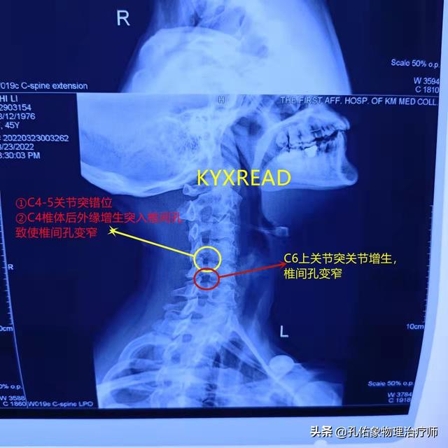 肩胛骨疼痛、手麻、整天头昏脑胀，是更年期综合症吗？不要被糊弄