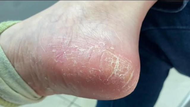 角化字足癣能治好吗