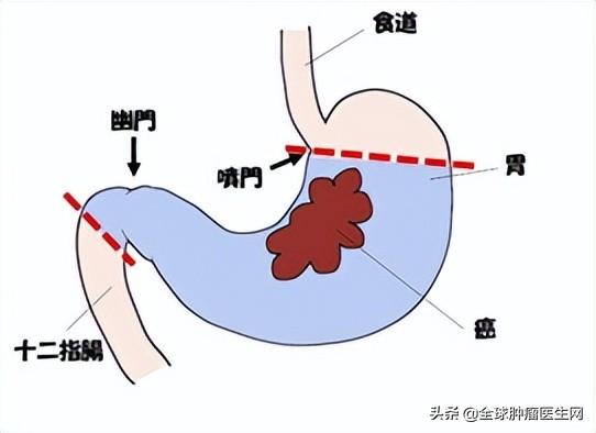 日本的胃癌治疗到底有多强？看完这篇文章你就知道了