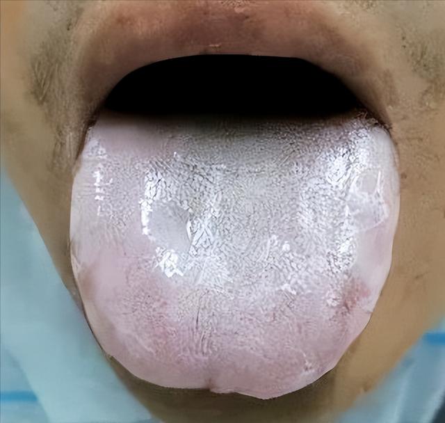 舌象分析，看看正常的和异常的舌象对比