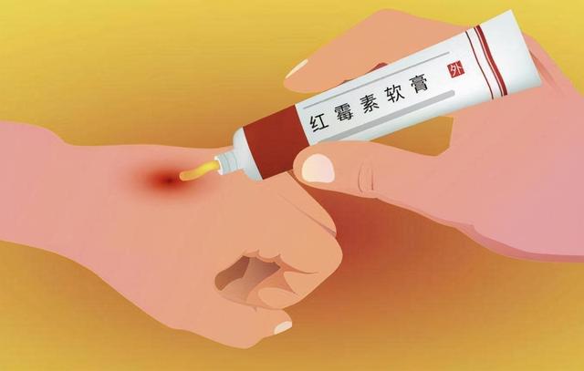 皮肤脂溢性角化症擦什么药膏