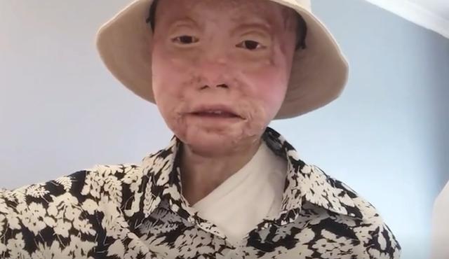 乔燕：因汽车自燃被烧伤，全脸毁容双手截肢，928天后涅槃重生