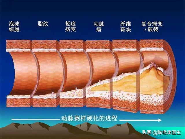 55岁大叔斑块消失，他长期坚持3个“护血管”方法，行之有效