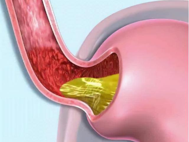 奥美拉唑、兰索拉唑、泮托拉唑、雷贝拉唑有何区别？哪个作用最好