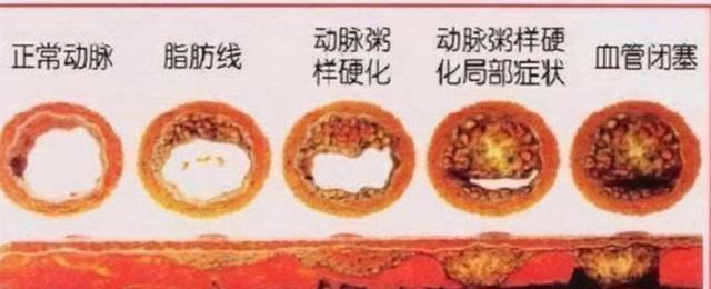 王先生坚持每天喝红酒“软化血管”，半年后他怎么样了？