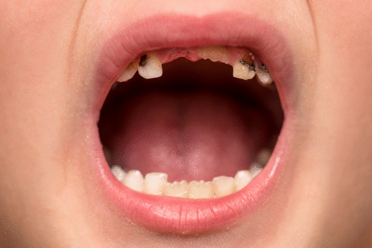 Denti莎卡联合丁香妈妈，保障儿童牙齿健康