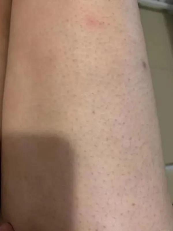 鸡皮肤怎么遮挡