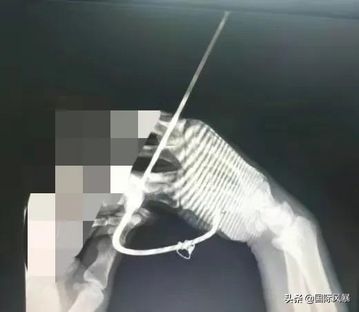 巴西土狗多次挑战豪猪，脸上却被扎满数百根刺，狗主人：免费针灸