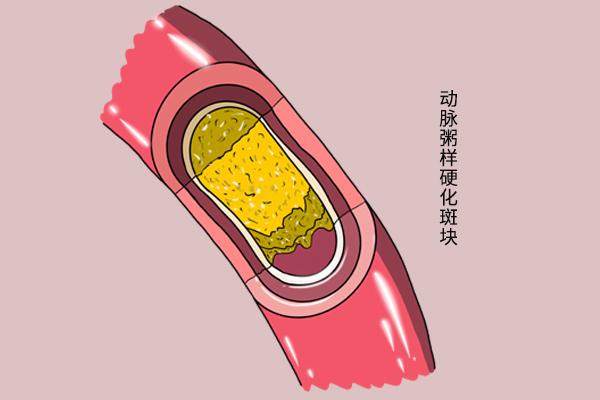 每天吃一片阿司匹林，结果会如何？利弊分析给你，请早知晓