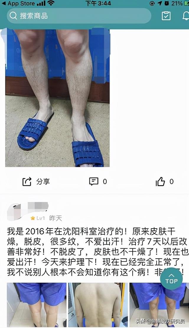 鱼鳞病有人治好的吗