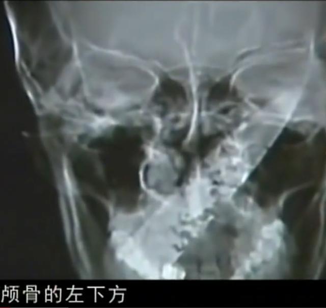 11年云南男子头疼呕吐，身上散发臭味，检查发现脑中插着一把匕首