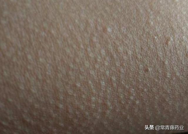 基因有鸡皮肤吗
