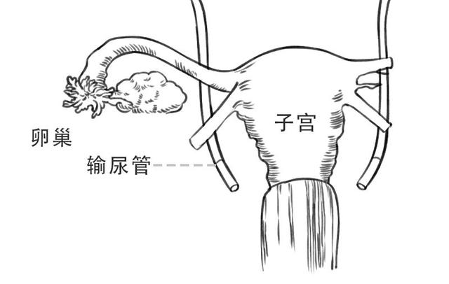 為什么有些宮頸癌患者會攜帶尿管回家？