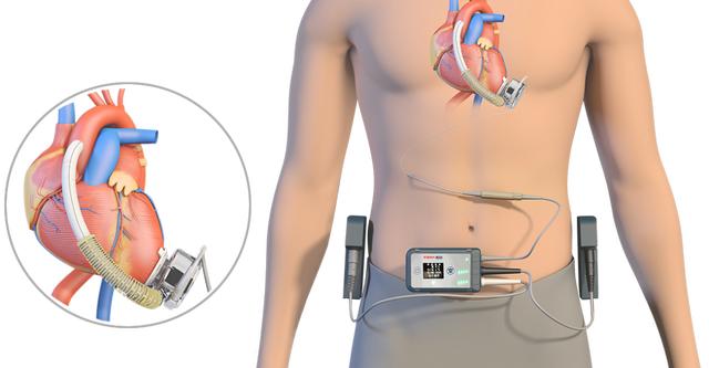 心衰患者植入人工心脏 950 天