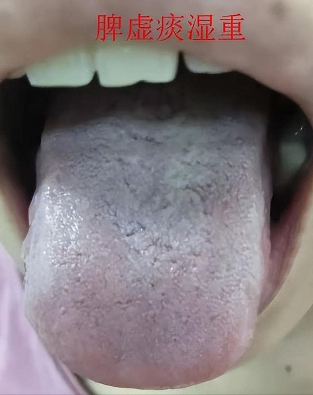 舌象分析，看看正常的和异常的舌象对比