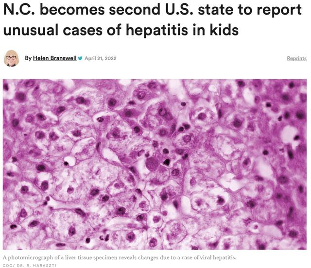 美国也出现了！不明原因肝炎席卷12国，已有死亡病例
