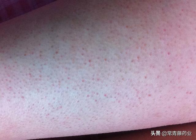 鸡皮肤比较厉害跟内分泌有关系么