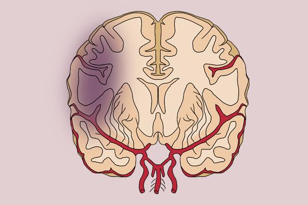 为何国内脑梗多，美国脑梗少？研究4万人发现：叶酸或是关键-太公奇门网