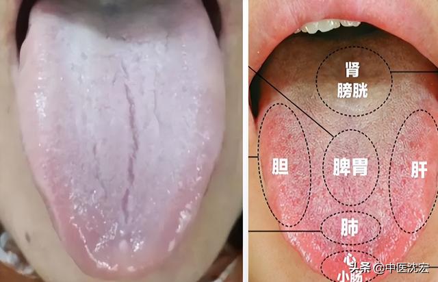 舌头有裂纹，究竟是身体出了什么问题？今天沈医生一次给你讲明白