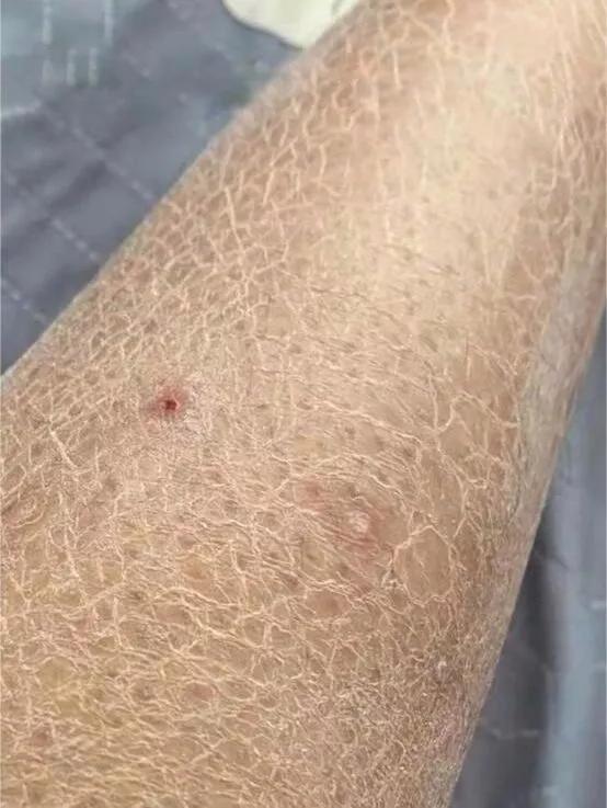 去除鸡皮肤腿部
