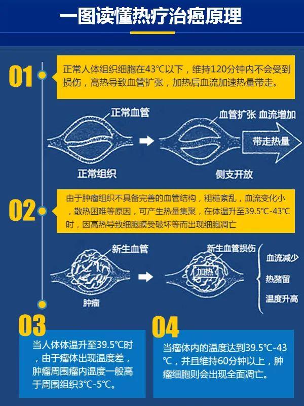癌細胞怕熱？熱療助力放化療阻擊逃逸癌細胞