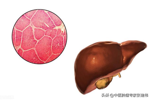預防肝癌其實并不難，堅持做好這6點，肝癌就會“遠離”你