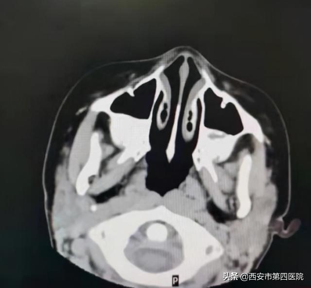 孩子反复咳嗽、鼻塞、流脓性鼻涕，以为是“感冒”？ 这都是鼻窦炎惹的祸！