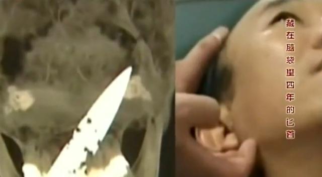 11年云南男子头疼呕吐，身上散发臭味，检查发现脑中插着一把匕首