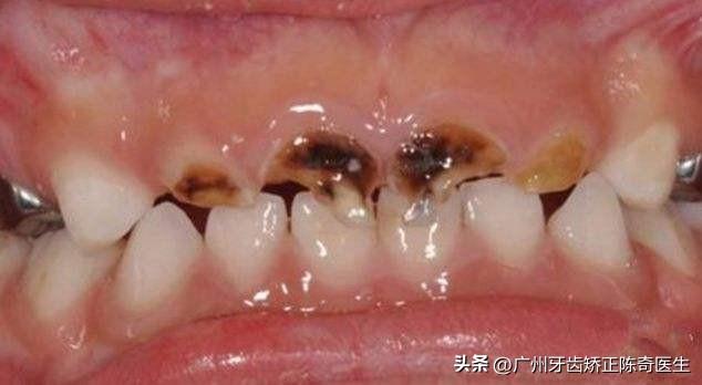 為什麼現在10個小孩里7個有蛀牙！別等小孩滿嘴爛牙再後悔 - 天天要聞