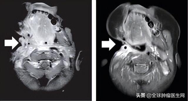 所有癌癥患者都應該檢測的泛癌種靶點NTRK，中美15種新藥已問世?
