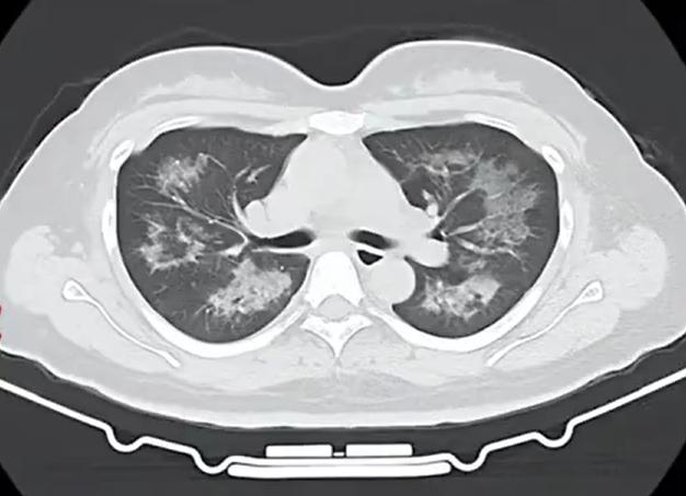 22歲主播肺里長滿陰影，只因每天都在用它！專家提醒→ - 