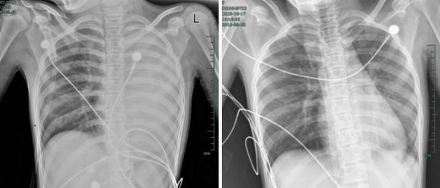 發熱僅1天，肺全白了！醫生：極度危險，千萬別當普通感冒 - 