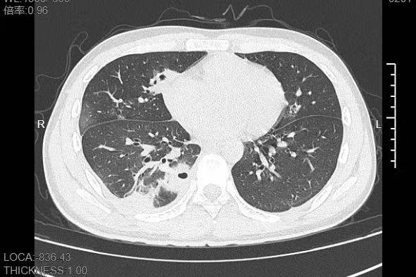 嚇人！20歲男生肺被“啃”出10多個空洞！只因一個常見動作……醫生提醒 - 