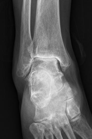 突破技術壁壘！連州人醫完成清遠首例人工全踝關節置換術