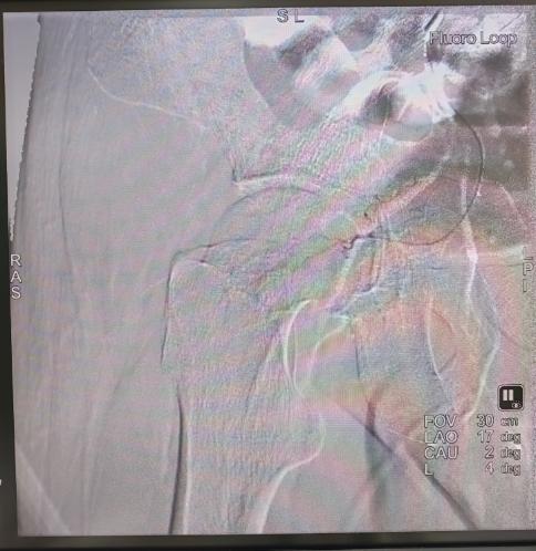 專科協作開新局 微創精準解頑疾 —— 市五院成功完成院內首例股骨頭缺血性壞死介入治療 - 