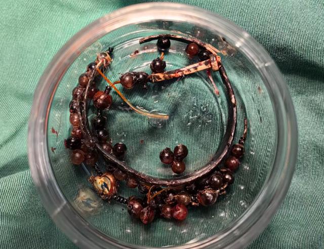 女子手鐲10年沒摘竟“長”進肉里！醫生：再晚點就保不住了 - 