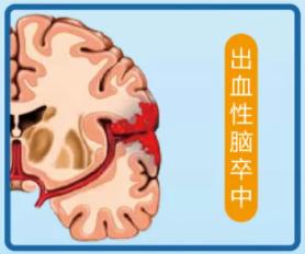 世界卒中日 | 天气转凉，快教会爸妈预防卒中“4要点”