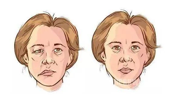 国医大师石学敏：经筋刺法及应用