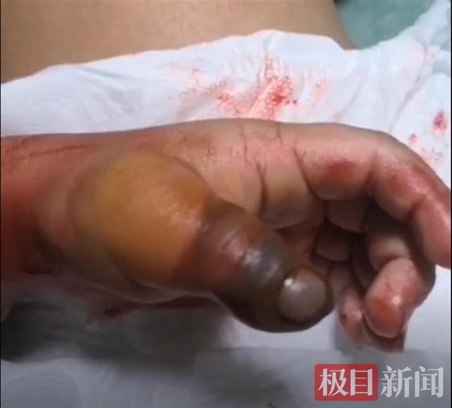 5岁姐姐好心办坏事，橡皮筋缠绕止血，2岁弟弟手指紫黑险截肢