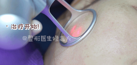 剖腹产留下的疤痕，你在意吗？来看看如何改善吧