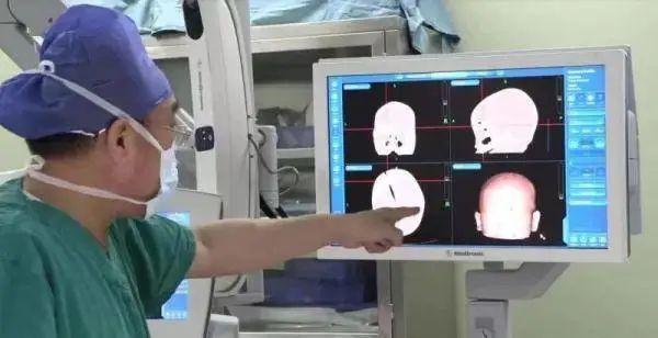 揪心！1岁女婴颅内留下4厘米断刀……