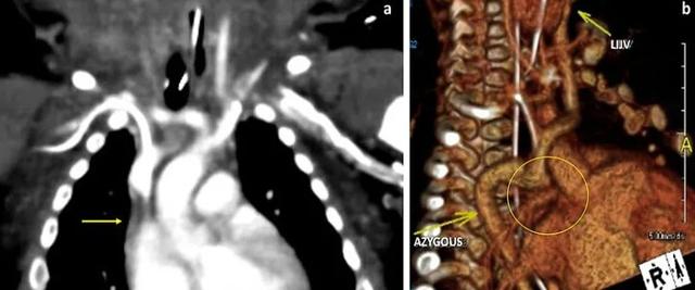 婴儿上腔静脉综合征