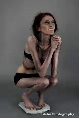 英国女子患厌食症难怀孕 调整后成功生育一名男婴