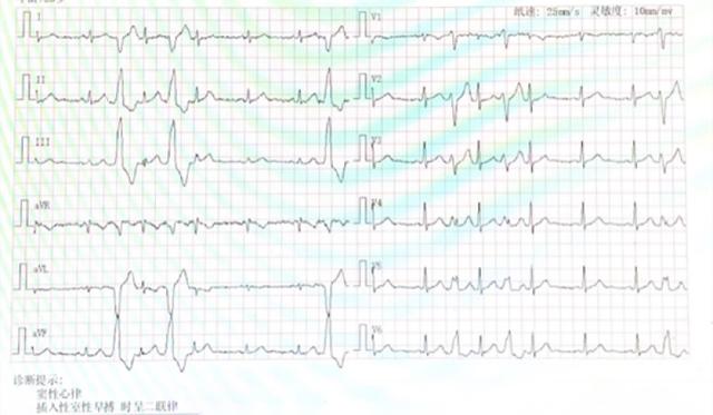 31周孕妈妈室性早搏：24小时5万多！“绿色消融术”让心悸变心安