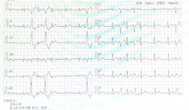 31周孕妈妈室性早搏：24小时5万多！“绿色消融术”让心悸变心安