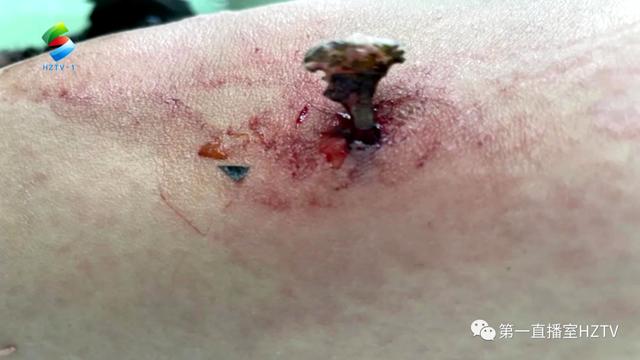 离奇！怀胎8月的孕妇走着路竟被鱼骨刺进大腿…